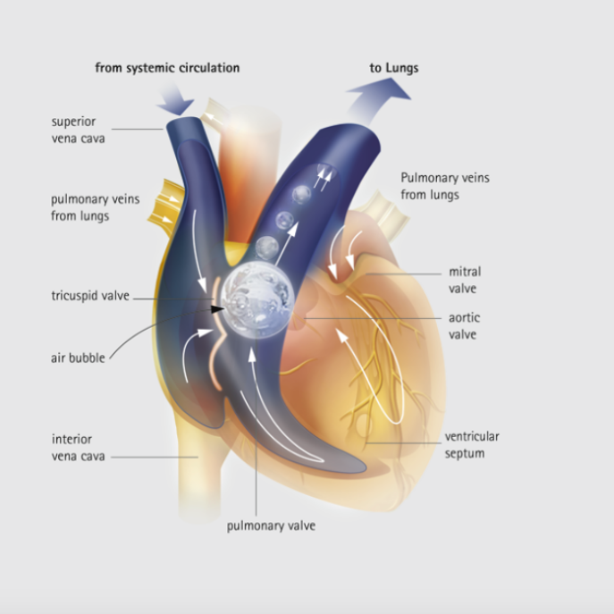 mini embolism