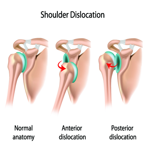 Shoulder Dislocation Classifications (www.backandbodyclinic.co.uk)