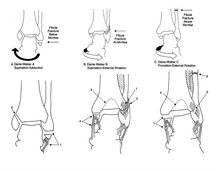 Ankle Injury Classification (Schwartz 2008)