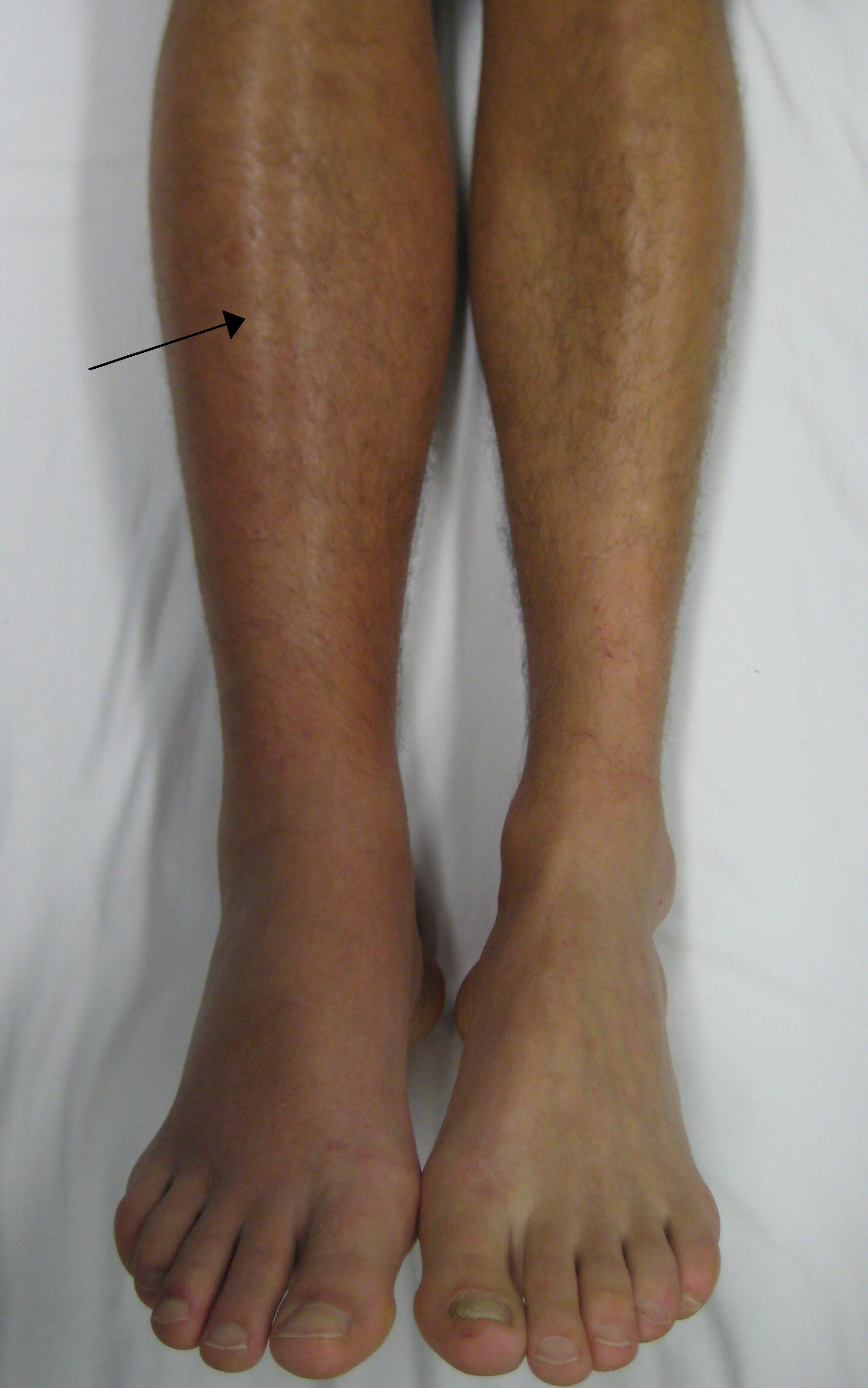 Unilateral Leg Swelling