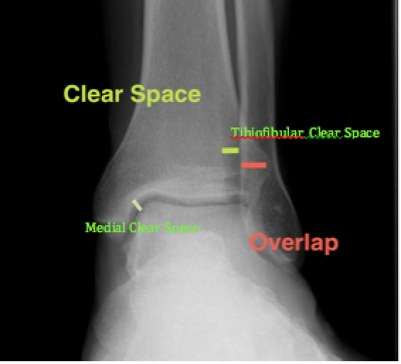 Normal AP Ankle X-Ray (http://posterng.netkey.at/)