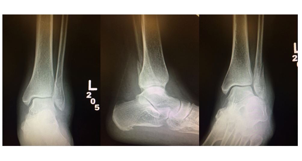 Our Patient's Ankle Series (AP, Lateral + Mortise Views)