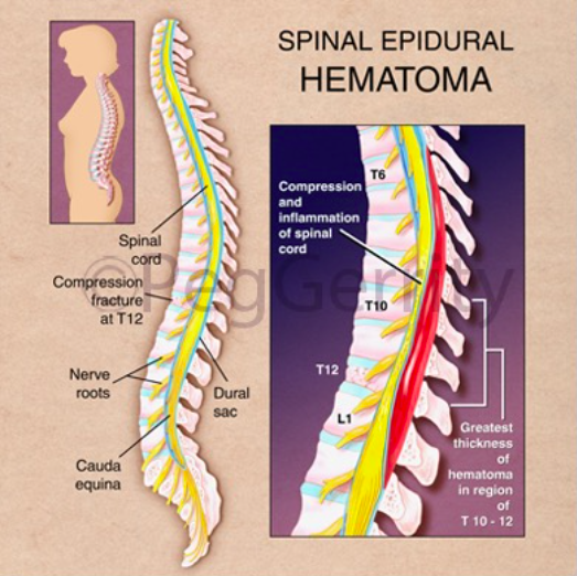 Spinal Epidural Hematoma – Core EM