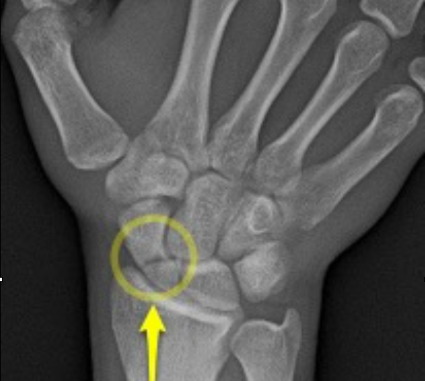 carpal bone fracture