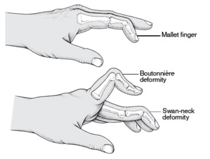 Boutonnière Deformity - OrthoInfo - AAOS