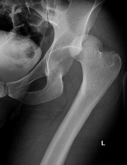 Hip Dislocation – Core EM
