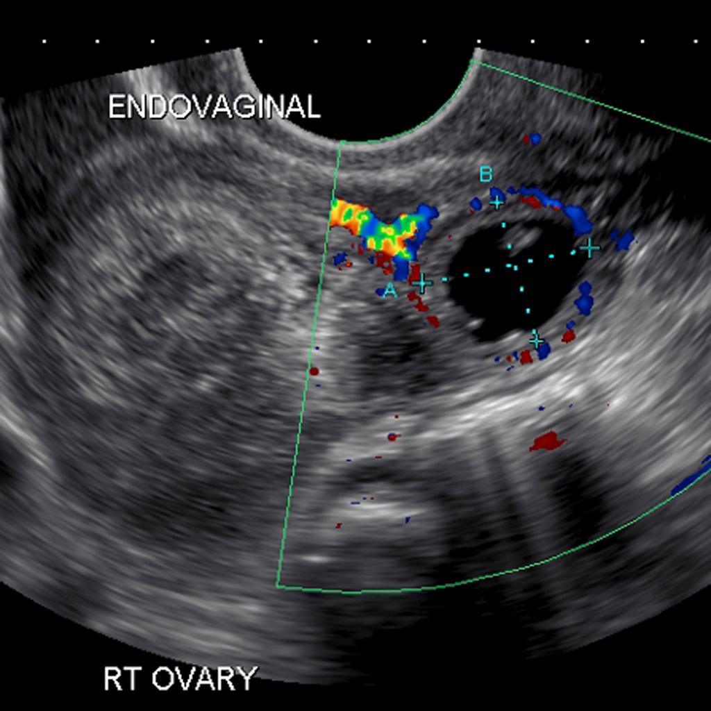Ruptured Ectopic Pregnancy Ultrasound