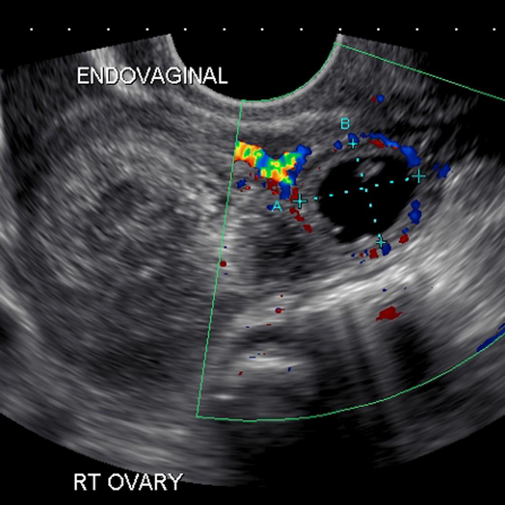 ectopic-pregnancy-core-em