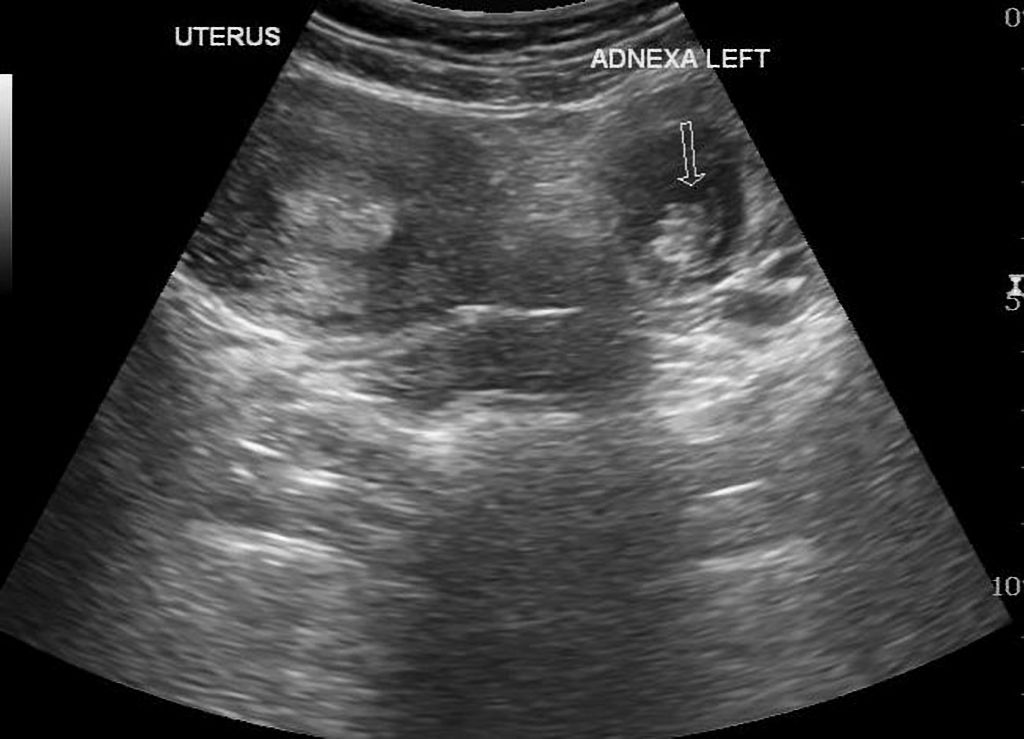 На узи видно внематочную. УЗИ при внематочной беременности. Внематочная беременность на УЗИ фото. Брюшная внематочная беременность на УЗИ. Внематочная беременность в брюшине.