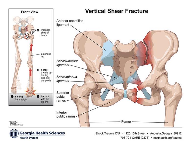 What are the different types of pelvic fracture?