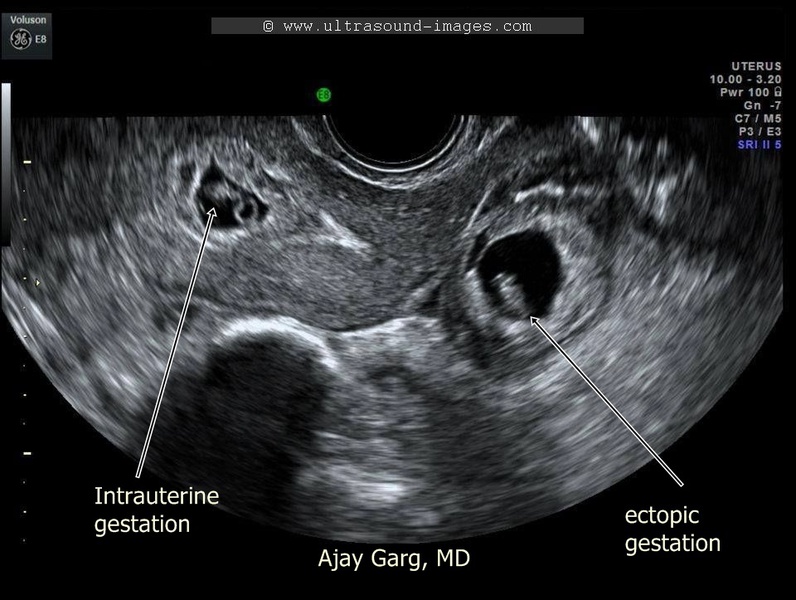 Image result for heterotopic vs ectopic pregnancy in ultrasound