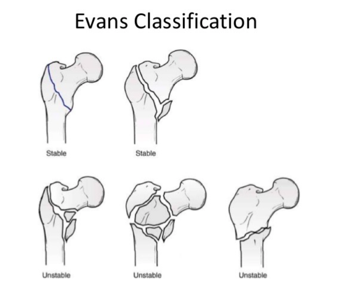 evans hip fracture classification