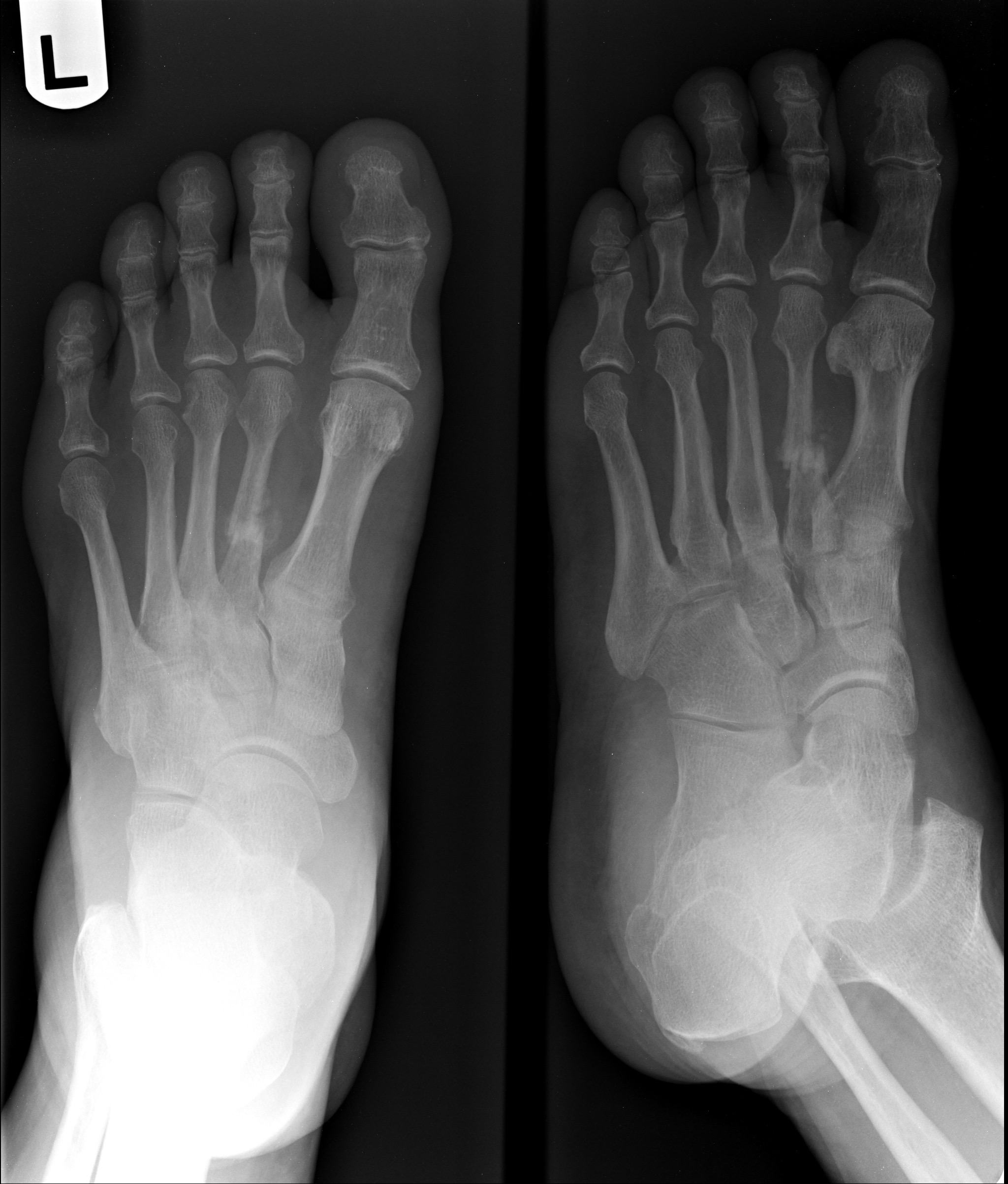 Epidemiology Imaging And Treatment Of Lisfranc Fracture Dislocations ...