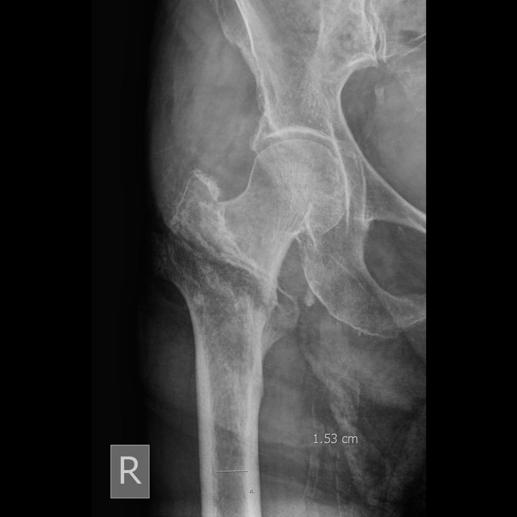 femoral neck fracture x ray