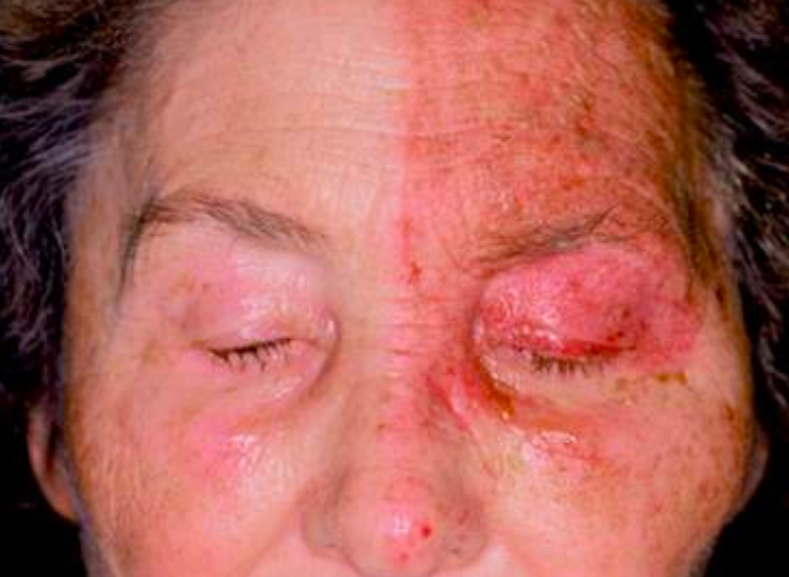dermatomes face shingles