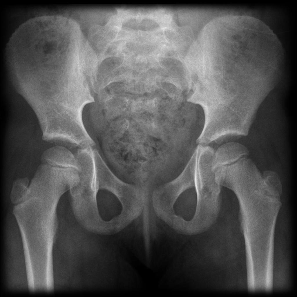 normal pediatric hip xray