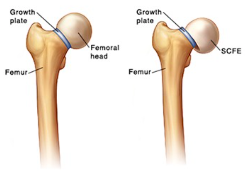 slipped capital femoral epiphysis