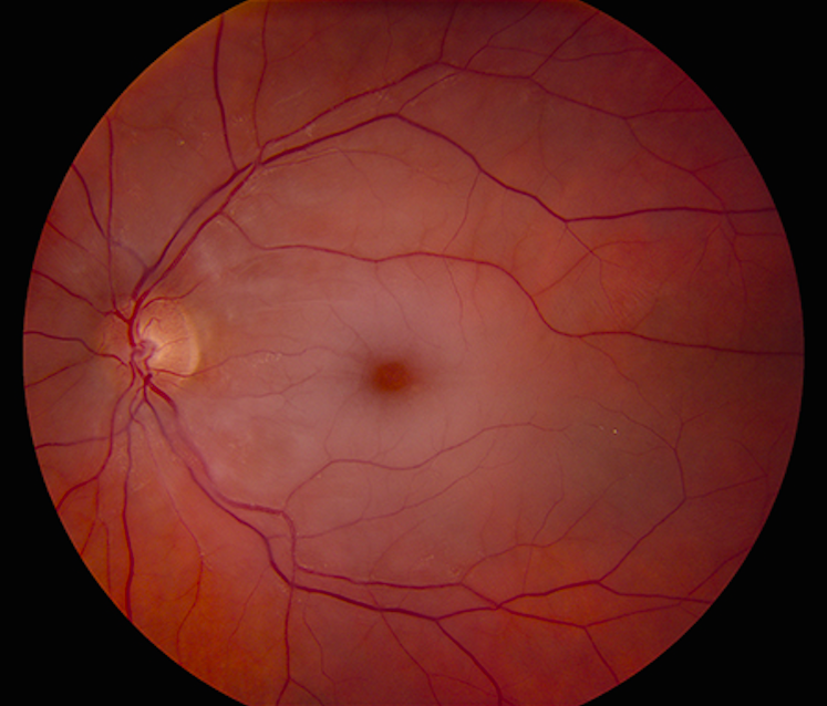 vision loss normal lens normal retina