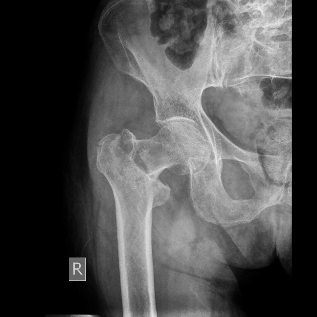 displaced subcapital femoral neck fracture
