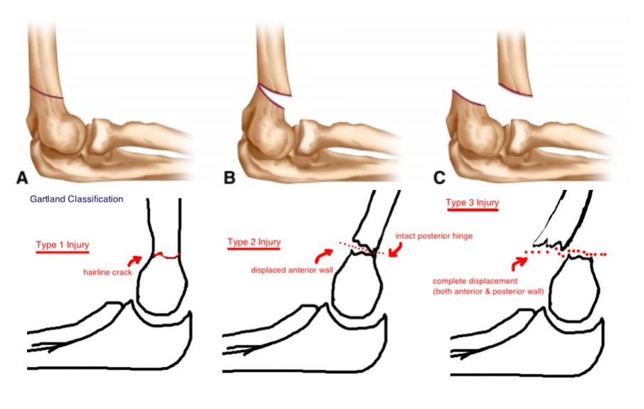 Pediatric Supracondylar Fractures Core Em 8615