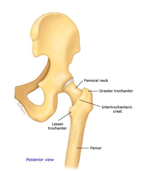 femoral neck fracture