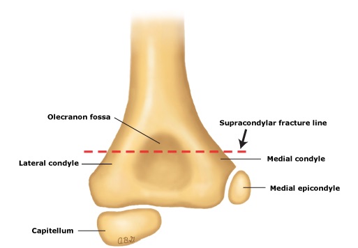 icd 10 code for supracondylar fracture