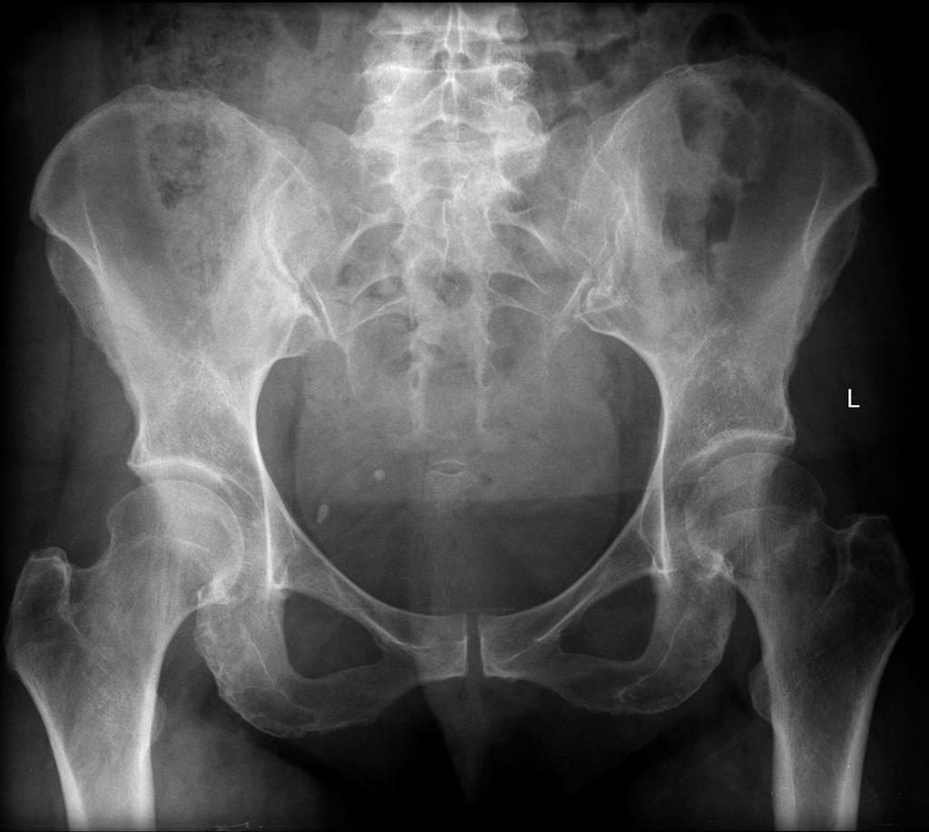 case study 3 1 displaced fracture of the femoral neck