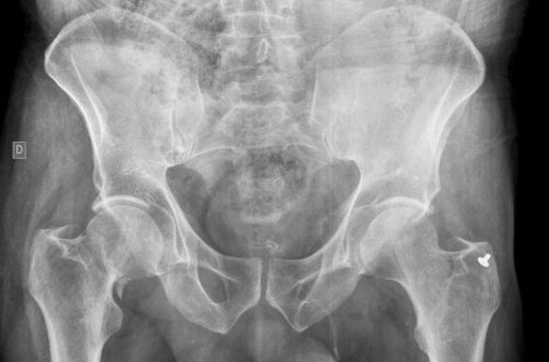 m syncope â Fractures EM Neck Femoral Core m syncope â Fractures EM Neck Femoral Core