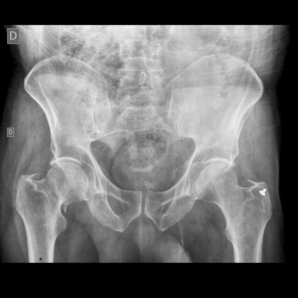 normal hip xray femoral neck fracture xray