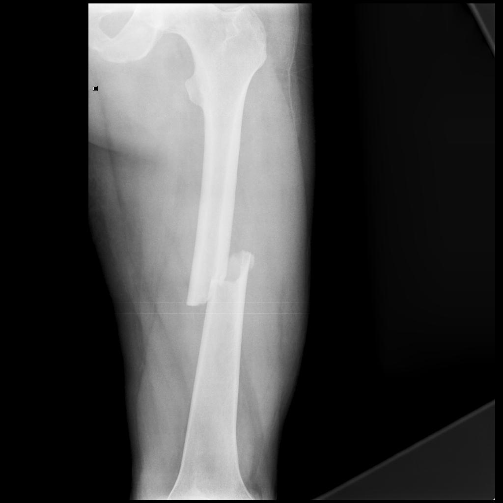 oblique bone fracture