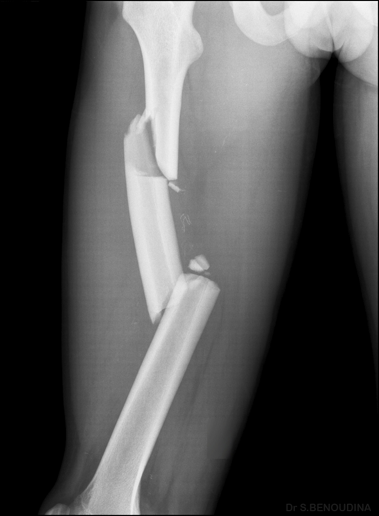 comminuted fracture common location