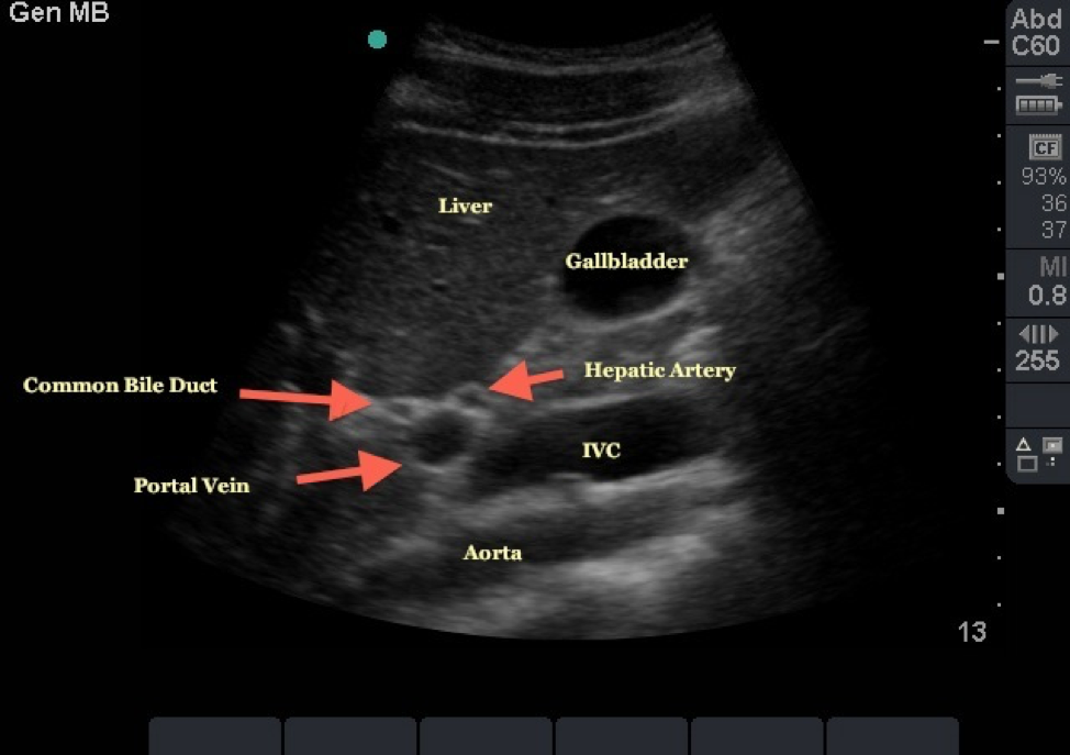 Biliary Ultrasound – Core EM