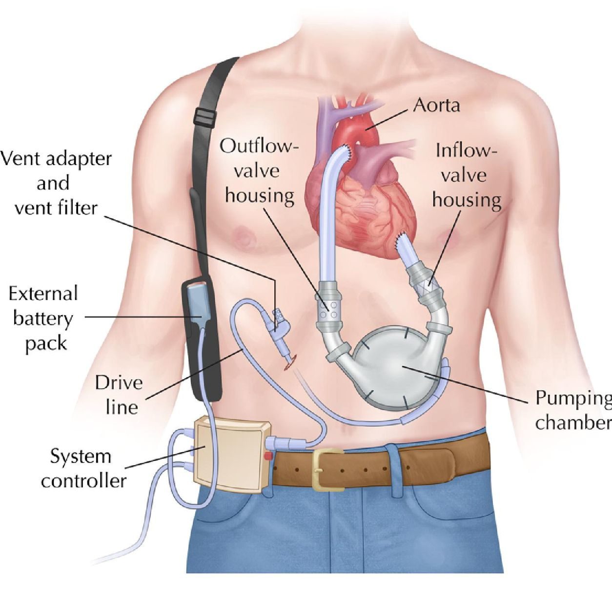 LVAD Back Pack