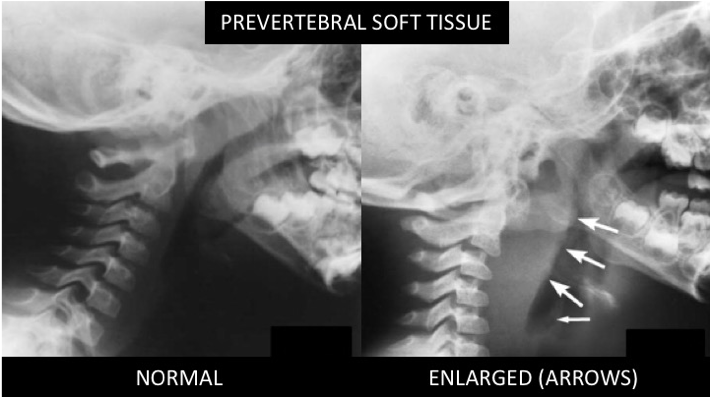 peritonsillar abscess x ray