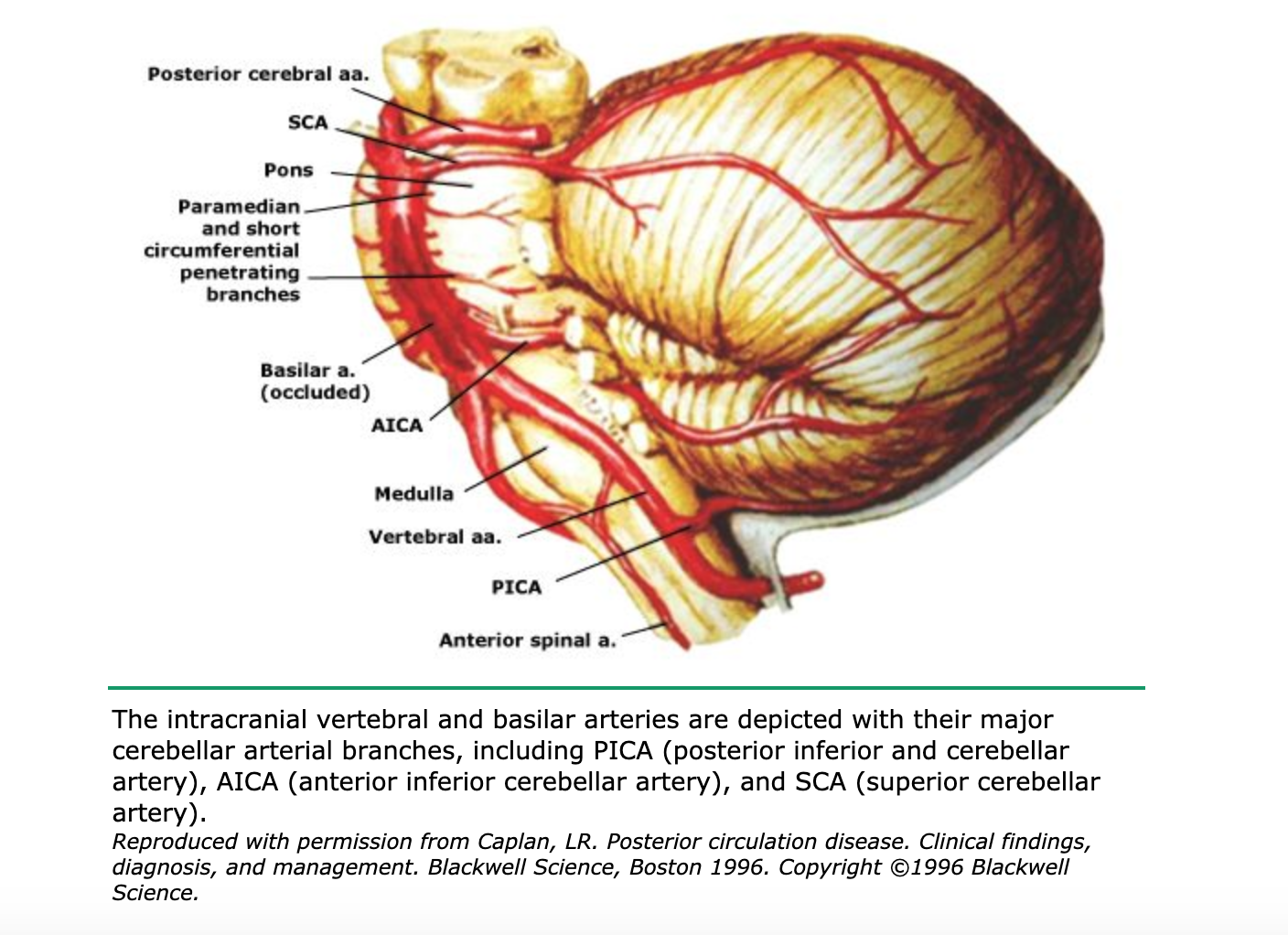 posterior inferior cerebellar artery stroke