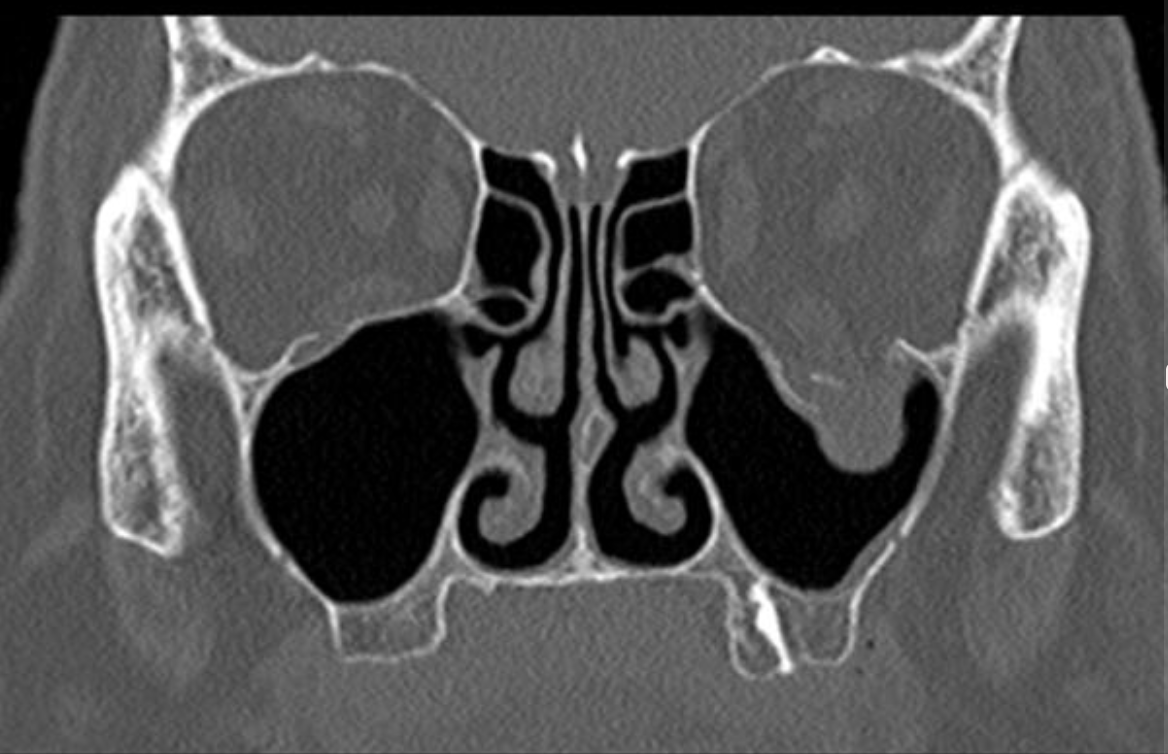 blowout fracture