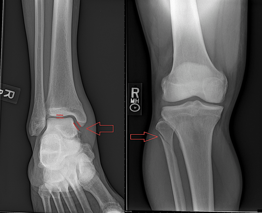 Bimalleolar ankle fracture, Radiology Case