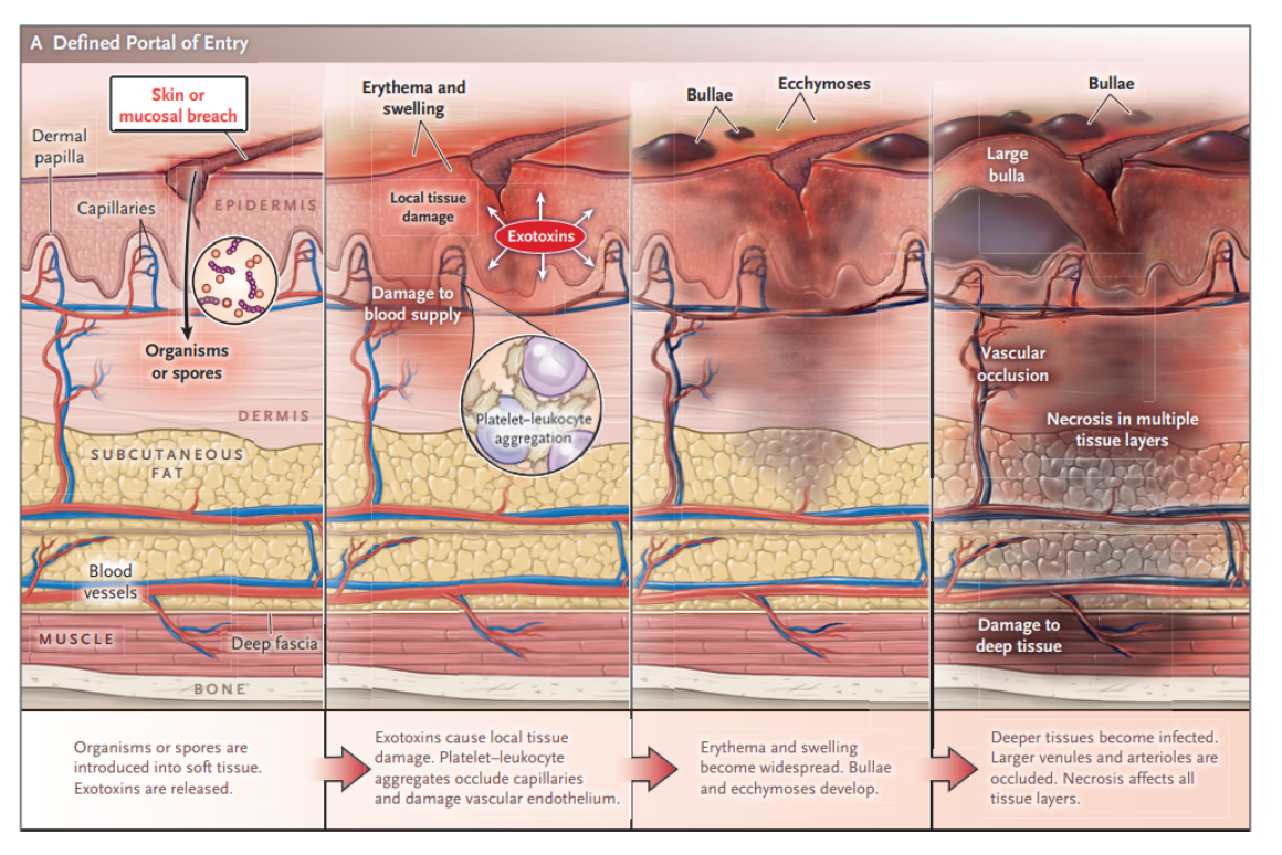 Necrotizing Soft-Tissue Infections