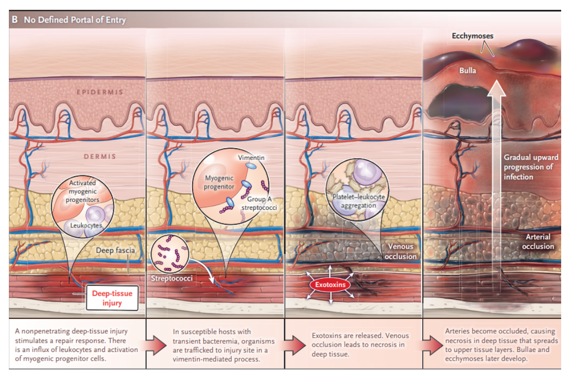 Ultrasound Diagnosis of Necrotizing Soft Tissue Infections – Core EM