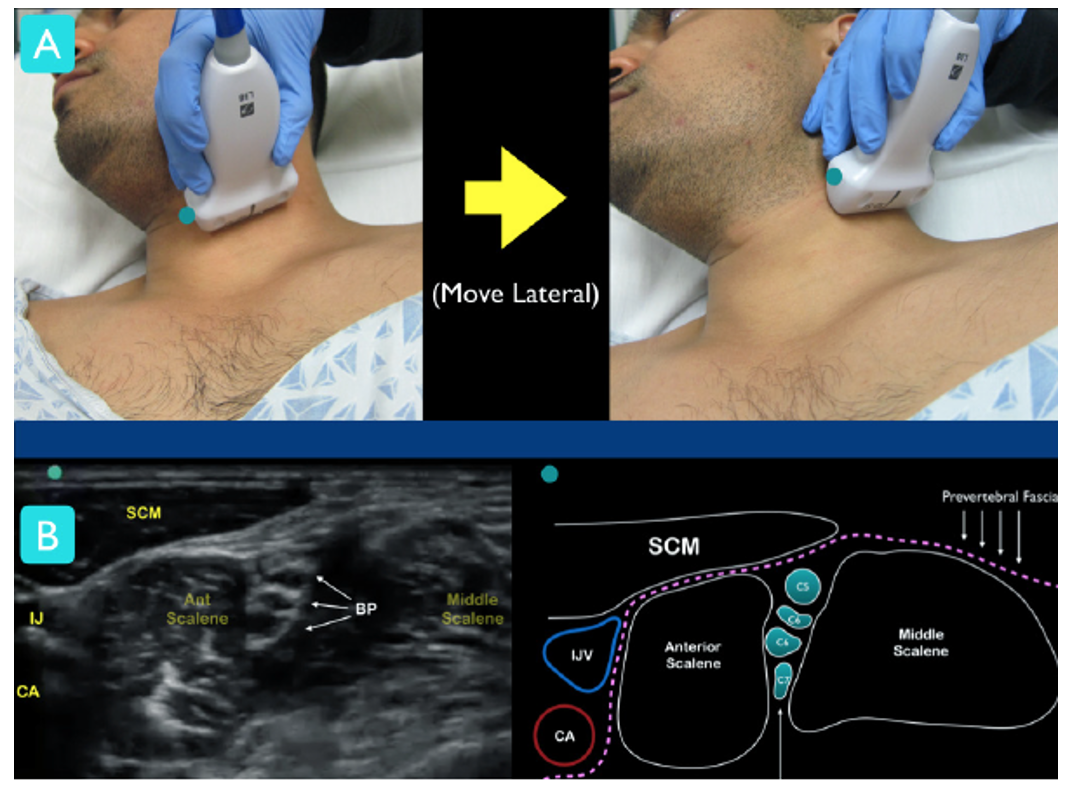 Ultrasound-Guided Interscalene Brachial Plexus Nerve Block – Core EM