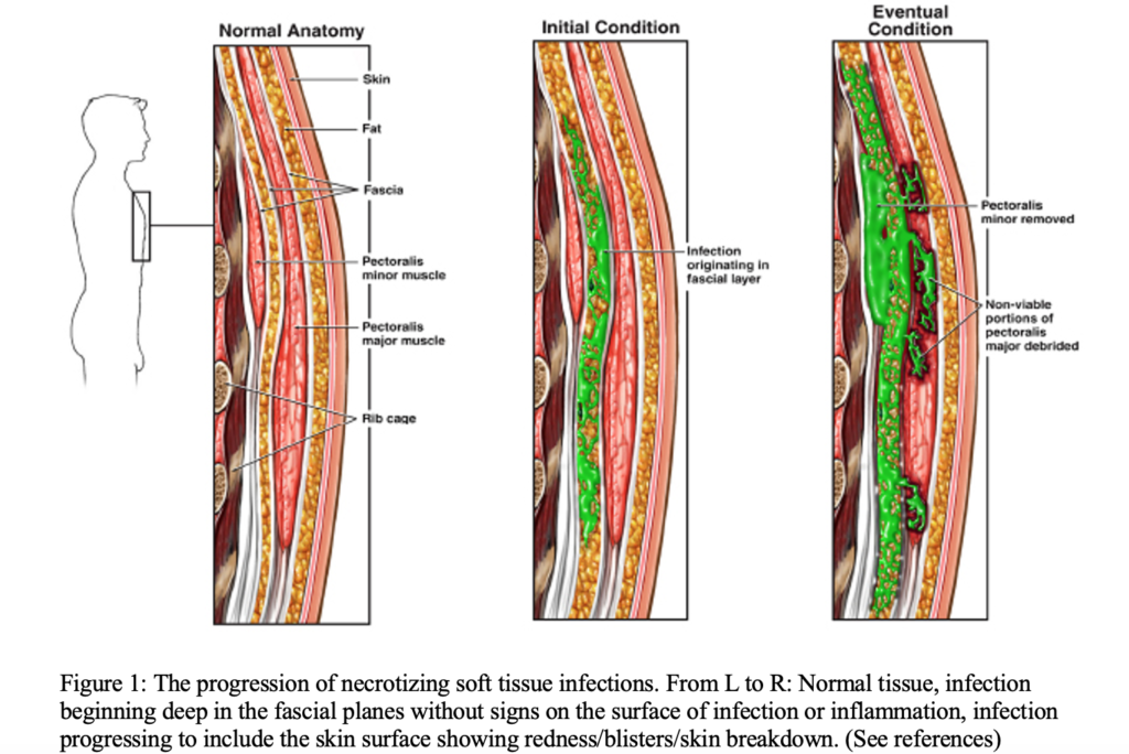 necrotizing fasciitis progression