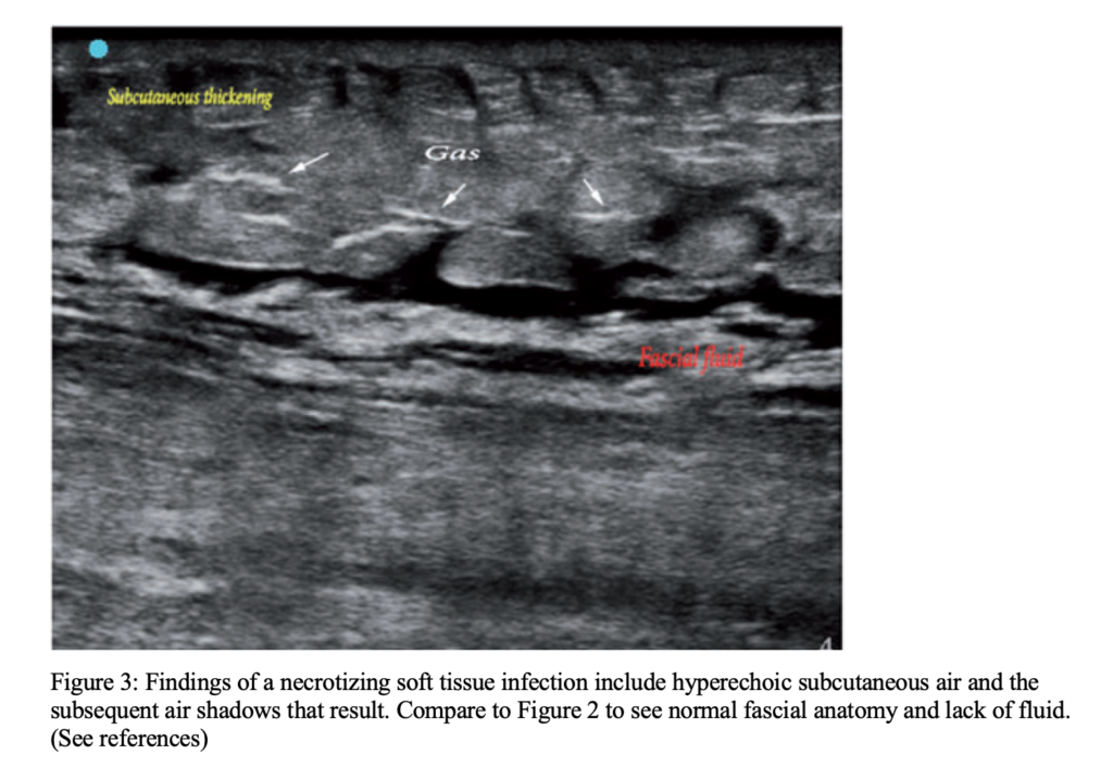 Ultrasound Diagnosis Of Necrotizing Soft Tissue Infections Core Em