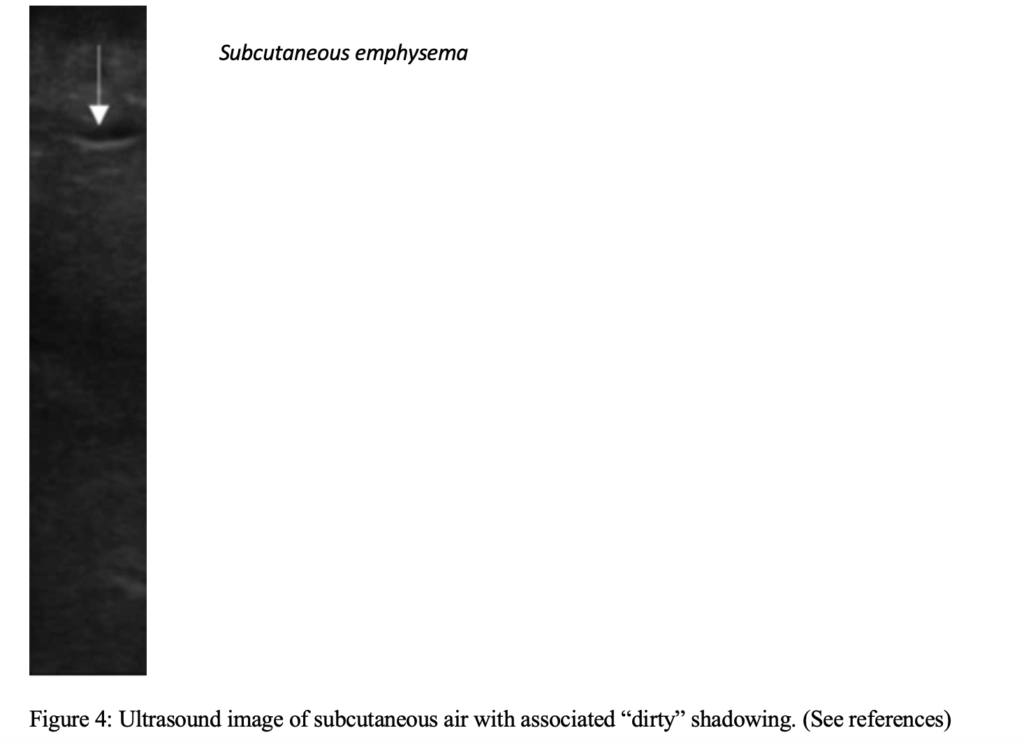 Ultrasound Diagnosis of Necrotizing Soft Tissue Infections – Core EM