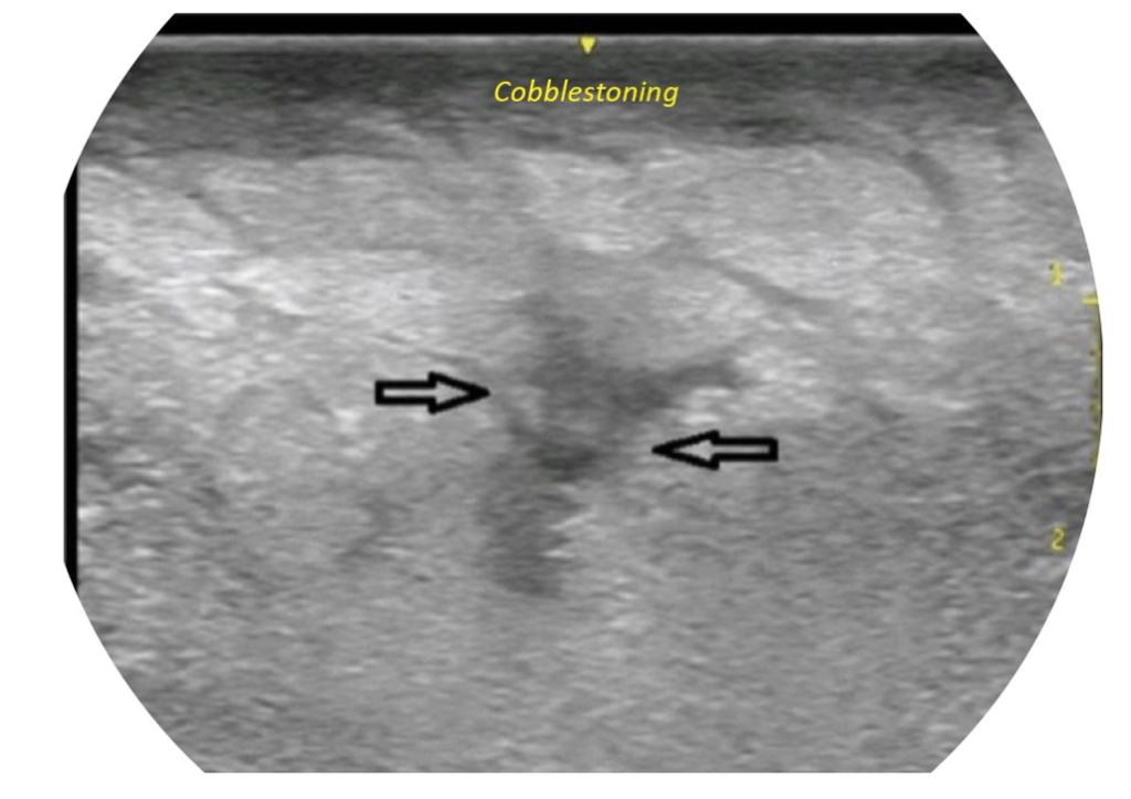 Necrotizing Soft-Tissue Infections