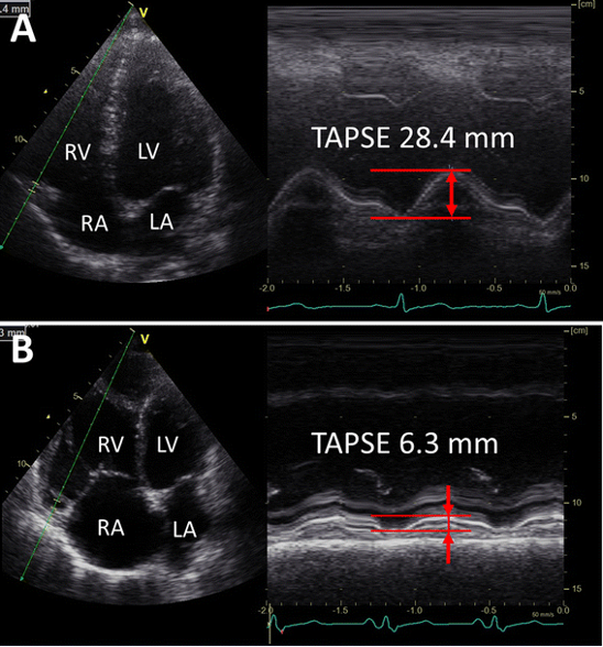 Right Lateral Excursion Picture Point-of-Care Ultrasound for Suspected Pulmonary Embolism – Core EM